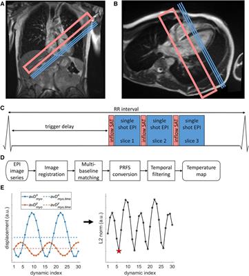 Feasibility of cardiac MR thermometry at 0.55 T